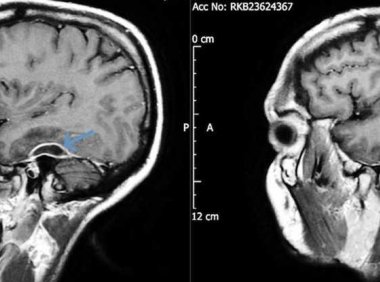 为什么你需要放下棉签用于耳朵清洁