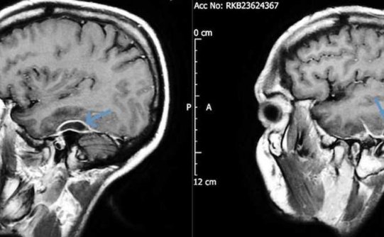 为什么你需要放下棉签用于耳朵清洁