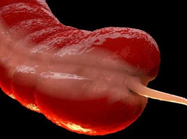 一项大型研究表明,失去阑尾和帕金森氏症之间有着奇怪的联系